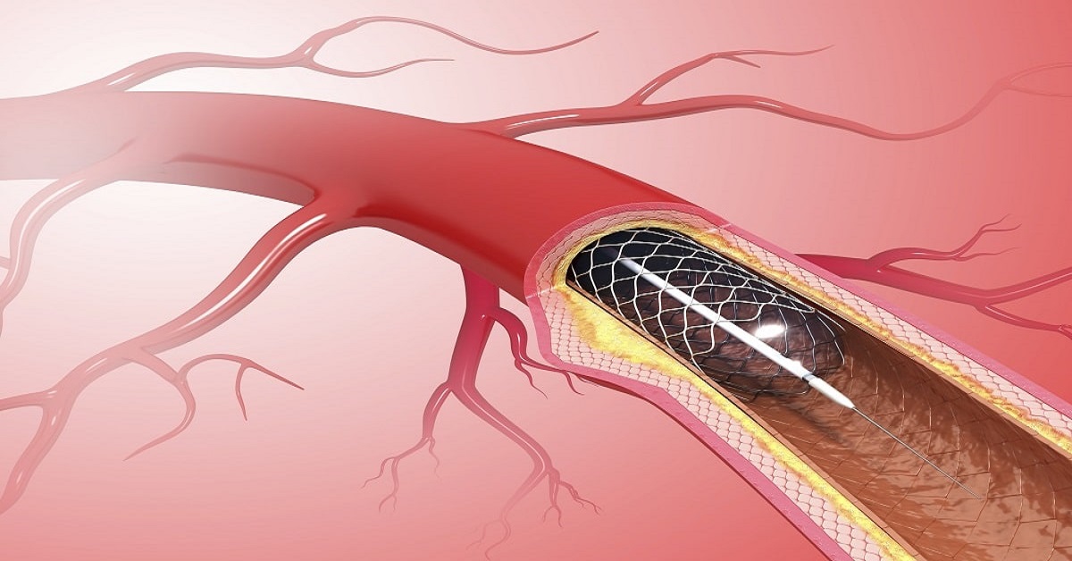 Coronary Stent for Heart Problem